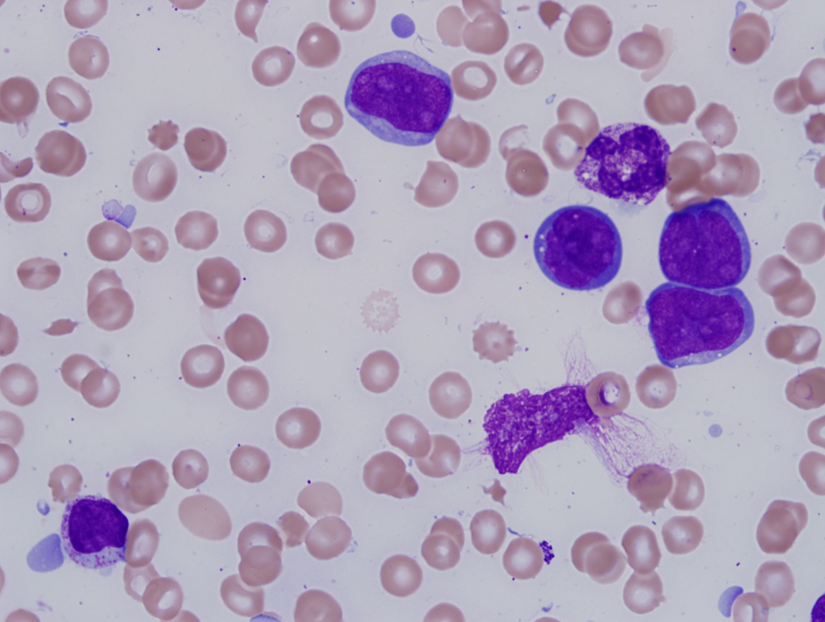 BM biopsy 2 direct 100x